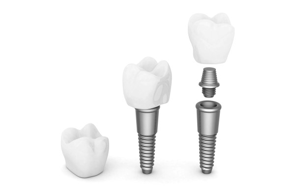 What Materials Are Used To Make An Implant Crown?